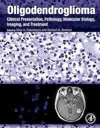Téléchargez le livre :  Oligodendroglioma