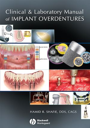 Download the eBook: Clinical and Laboratory Manual of Implant Overdentures