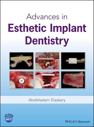 Download the eBook: Advances in Esthetic Implant Dentistry