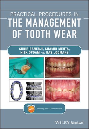 Download the eBook: Practical Procedures in the Management of Tooth Wear