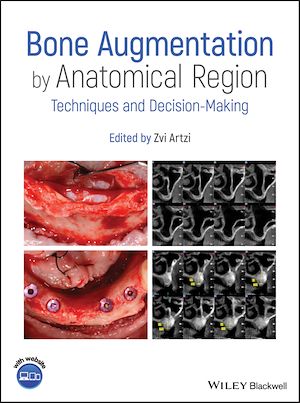 Download the eBook: Bone Augmentation by Anatomical Region