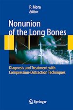 Télécharger le livre :  Nonunion of the Long Bones