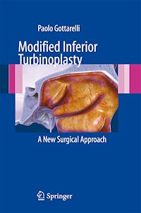 Télécharger le livre :  Modified Inferior Turbinoplasty