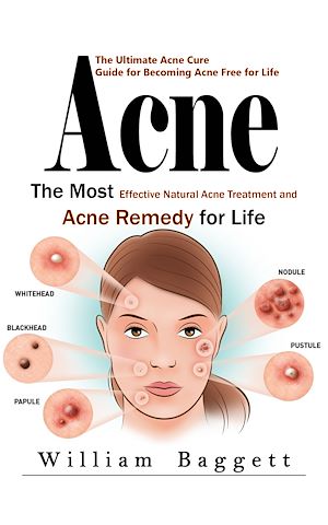 Téléchargez le livre :  Acne: The Ultimate Acne Cure Guide for Becoming Acne Free for Life (The Most Effective Natural Acne Treatment and Acne Remedy for Life)
